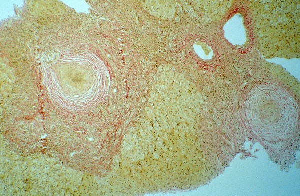 Schistosomiasis: histopathology of the liver