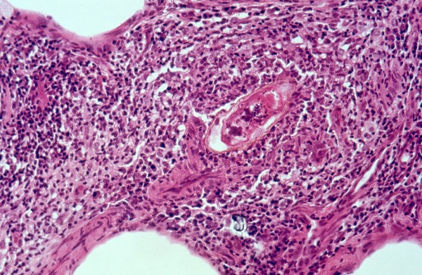 Schistosomiasis: histopathology of the lung