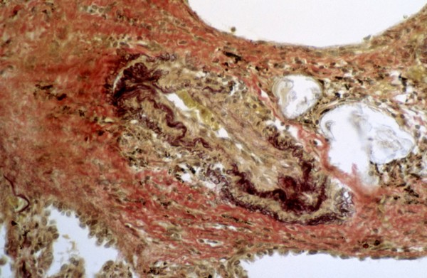 Schistosomiasis: histopathology of the lung