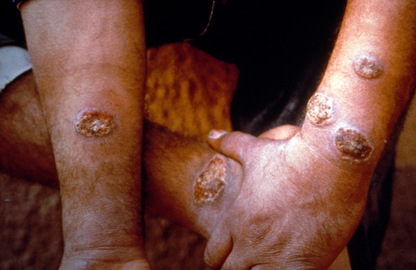 Old World cutaneous leishmaniasis (CL): multiple lesions