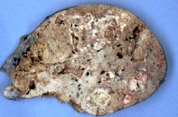 lung: Pneumocystis carinii pneumonia (PCP) with AIDS