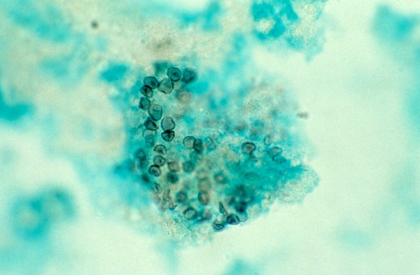 Lung: Pneumocystis carinii pneumonia (PCP) with HIV