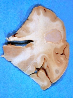 view Brain: cerebral toxoplasmosis