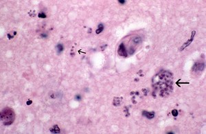 view Brain: toxoplasmosis