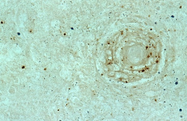 Brain: cerebral toxoplasmosis