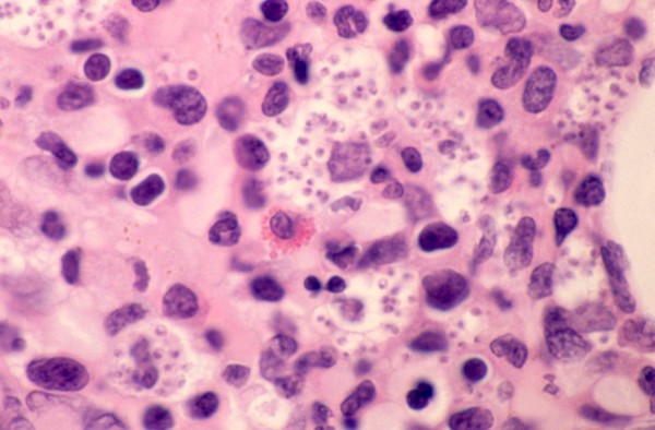 Bone marrow: leishmaniasis with HIV