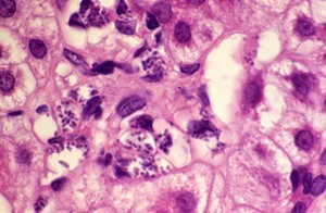 view Liver: leishmaniasis and hepatitis C