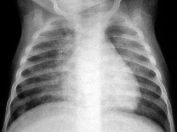 Pneumocystis carinii pneumonia (PCP) with HIV