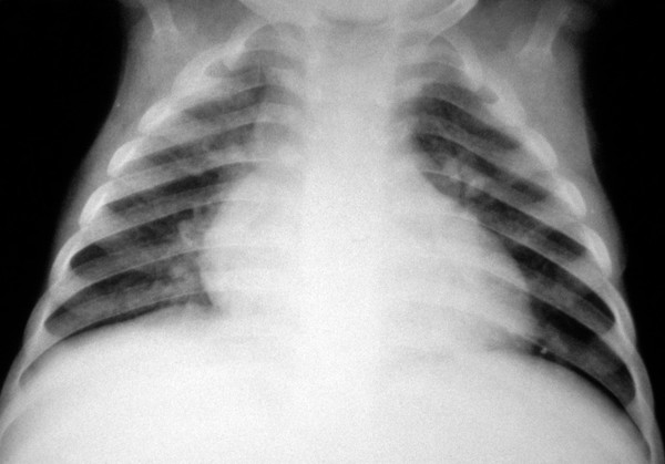 Lymphocytic interstitial pneumonitis (LIP) and HIV