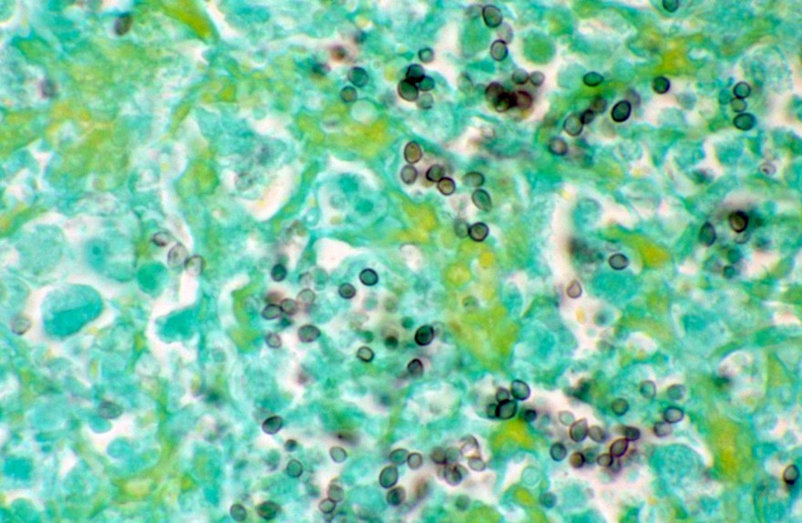 Lung: histoplasmosis