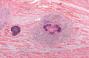 view Staphylococcus aureus infection: cardiac abscess