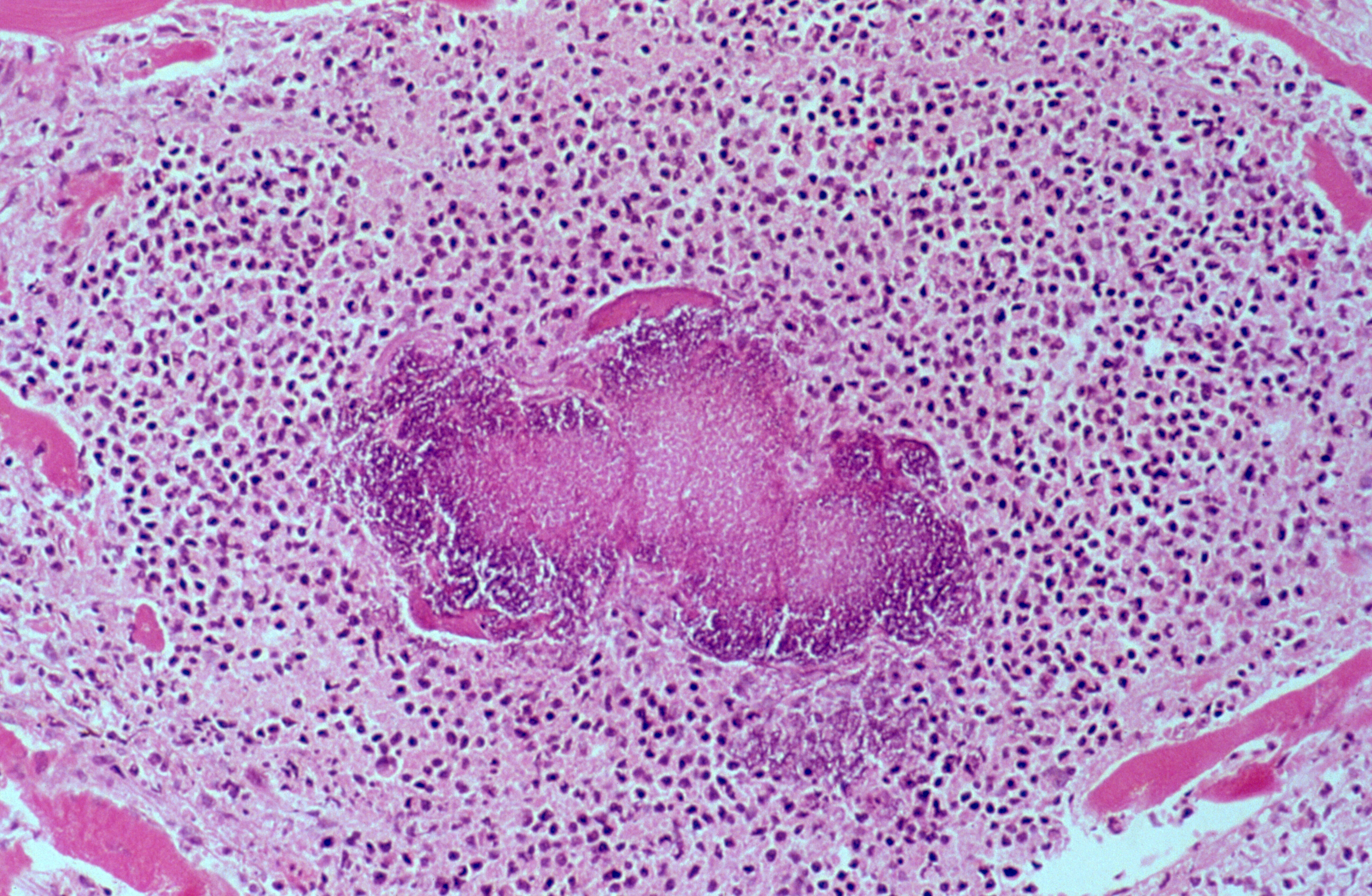 Staphylococcus aureus infection cardiac abscess Collection