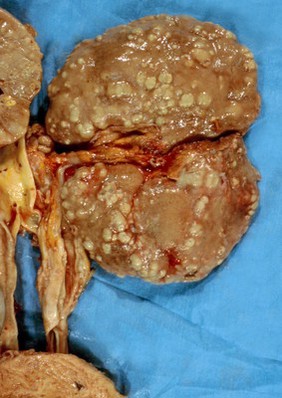 Kidney: pyaemic abscesses