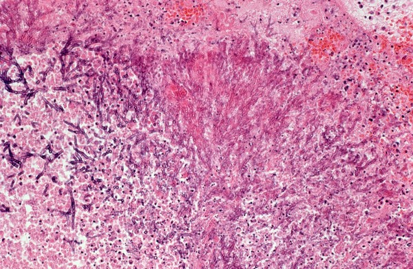 Lung: invasive pulmonary aspergillosis with AIDS