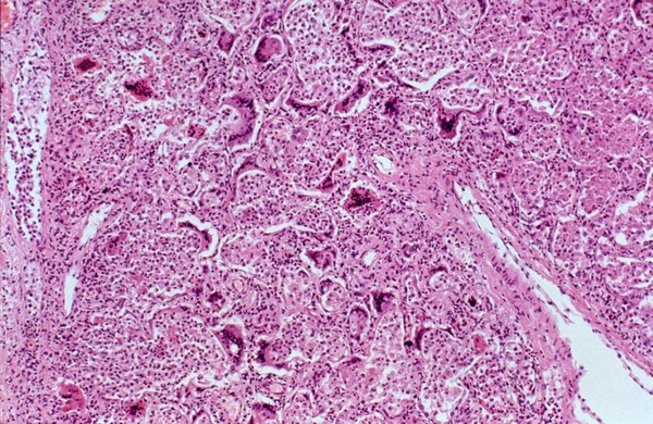 Lung: measles infection with HIV