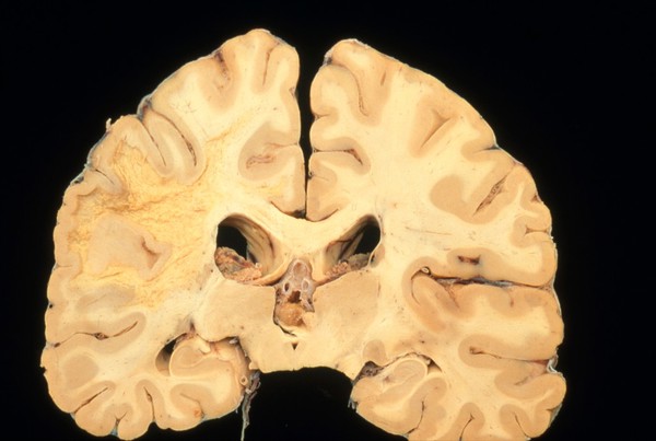 Brain: progressive multifocal leukencephalopathy with AIDS