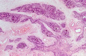 view Atrophy of the thymus in AIDS