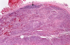 view Lymph node: Kaposi's sarcoma