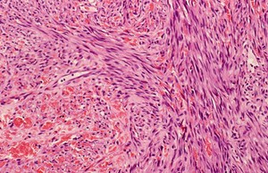 view Lymph node: Kaposi's sarcoma