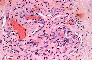 view Skin: Kaposi's sarcoma