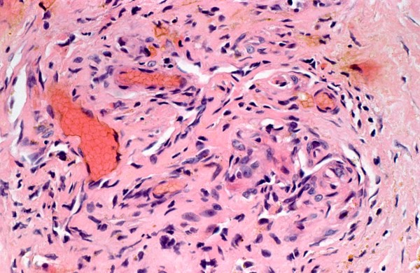 Skin: Kaposi's sarcoma