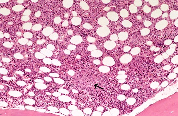 one marrow: Mycobacterium genavense infection