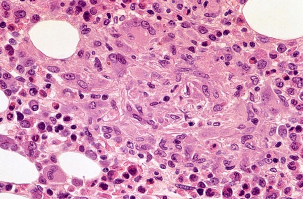 Bone marrow: Mycobacterium genavense infection with AIDS