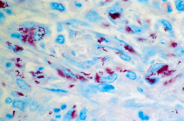 Bone marrow: Mycobacterium genavense infection