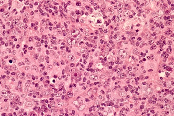 Epstein-Barr virus (EBV)-related lymphoproliferative disease