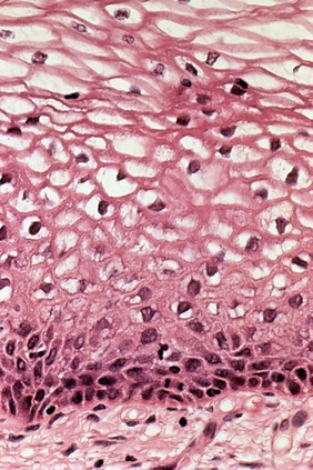 Cervix: human papillomavirus (HPV) infection