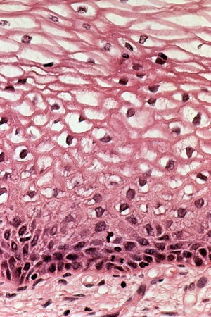 view Cervix: human papillomavirus (HPV) infection