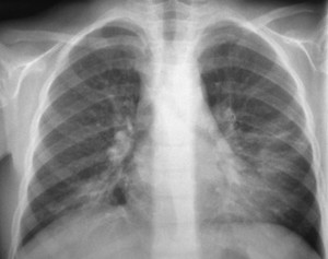 view Pneumonia: mycoplasma