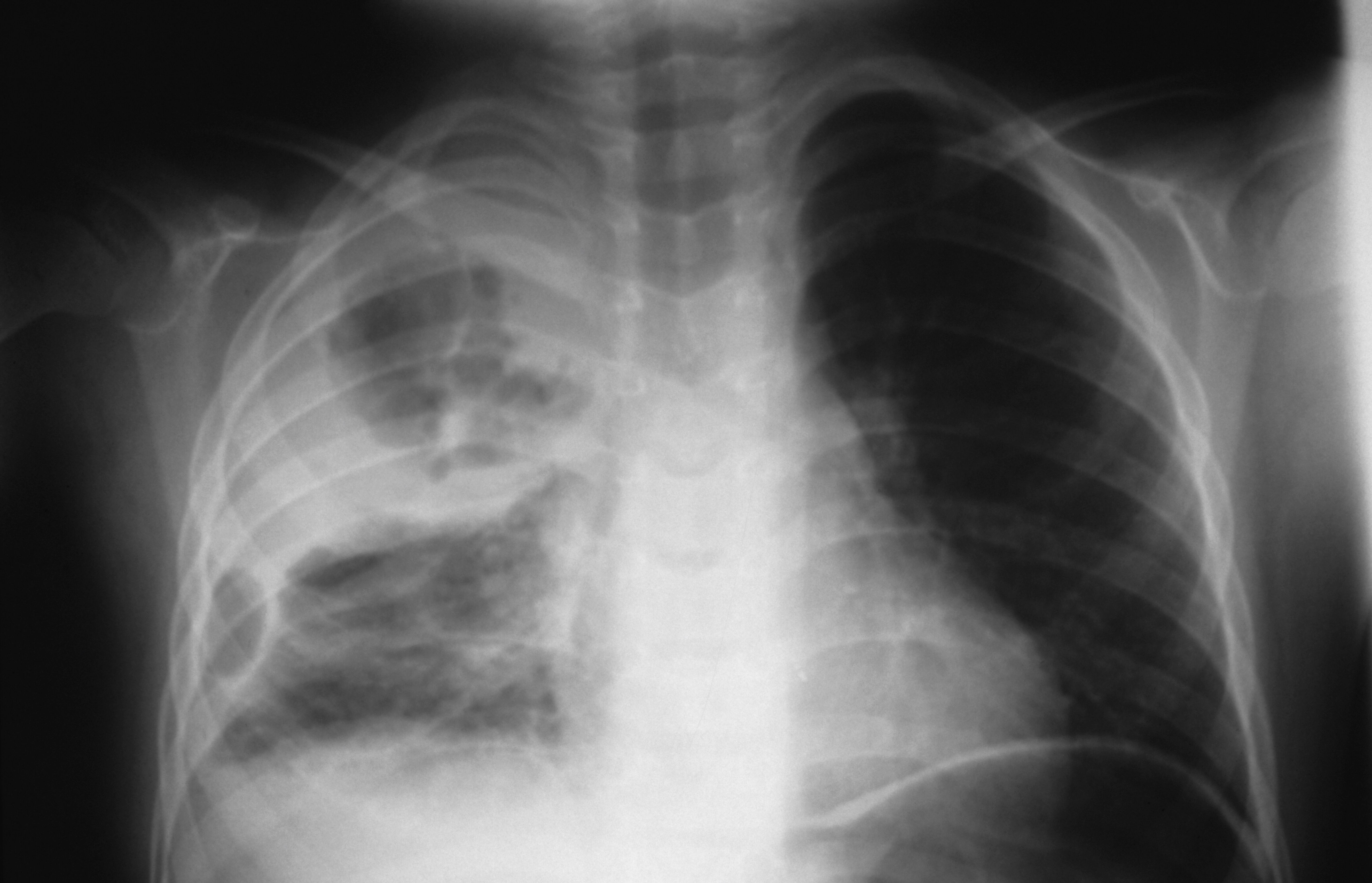 Chest X Ray Pneumonia Classification Freelancer vrogue.co