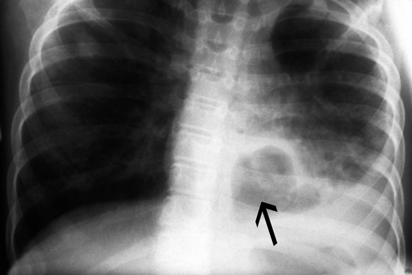 Pneumonia complications: lung abscess