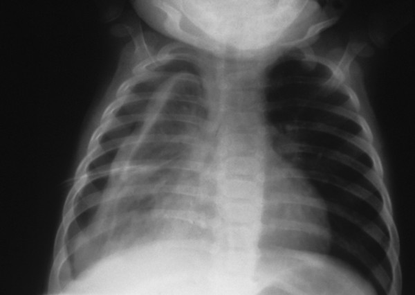 Pneumonia complications: empyema