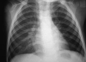 view Pneumonia complications: Macleod's syndrome (Swyer-James syndrome)