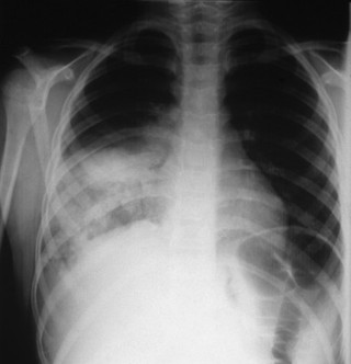 Pneumonia: mycoplasma