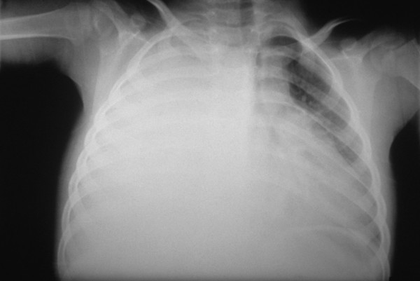 Pneumonia complications: empyema