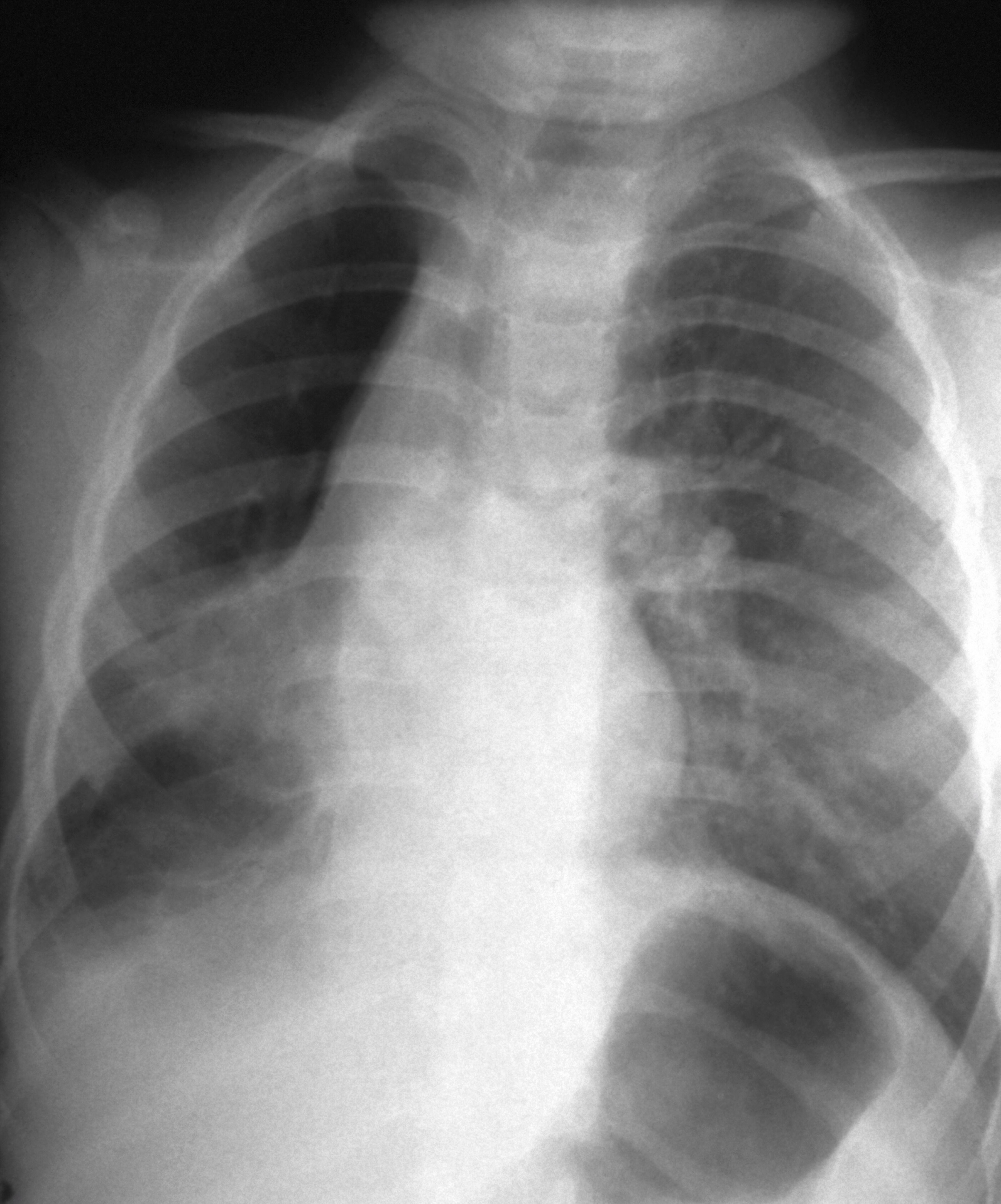 Pneumonia adenovirus wellcome collection
