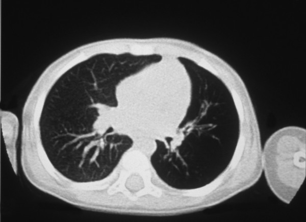 Pneumonia complications: Macleod's syndrome