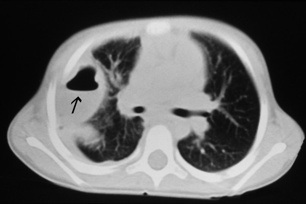 Pneumonia complications: lung abscess and pleural effusion