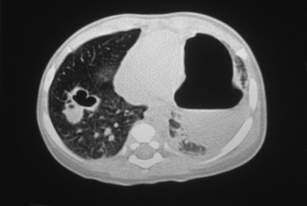 Pneumonia complications: lung abscess