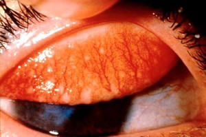 view Trachoma grading: trachomatous inflammation - follicular