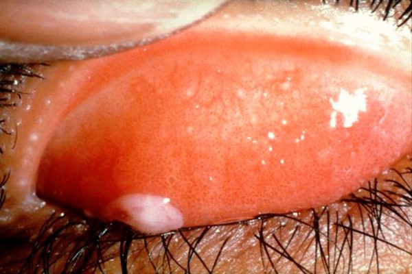 Trachoma WHO grade: trachomatous inflammation - intense (TI)