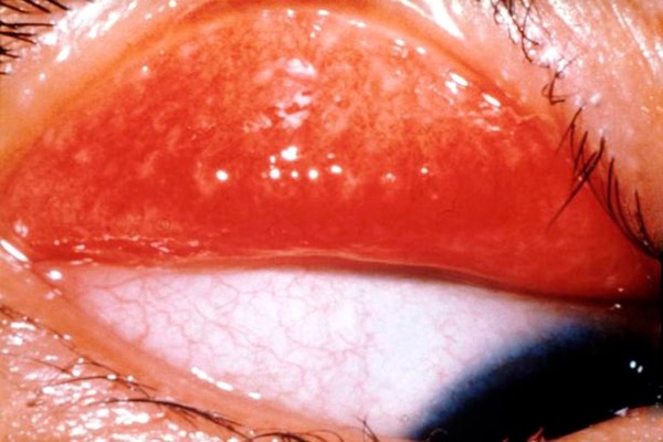 Trachoma WHO grade: trachomatous inflammation - TF with TI