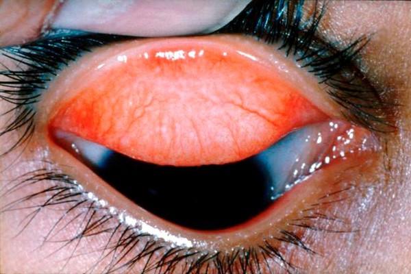 Trachoma WHO grade: trachomatous scarring (TS)