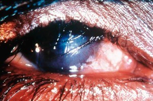 view Trachoma WHO grade: TT with CO