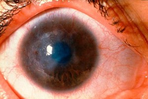 view Trachoma WHO grade: corneal opacity (CO)