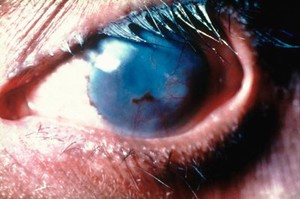 view Trachoma WHO grade: TT with CO