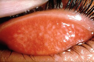 view Trachoma WHO grade: TF with TI